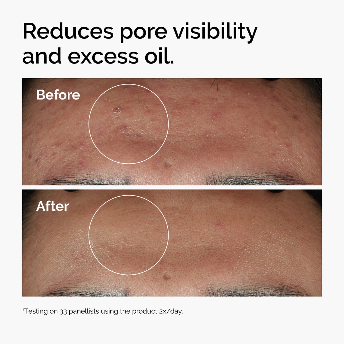 niacinamide-10-zinc-1-y0 ord-niacinamide-zinc-blemish-serum-before-after-pores.jpg