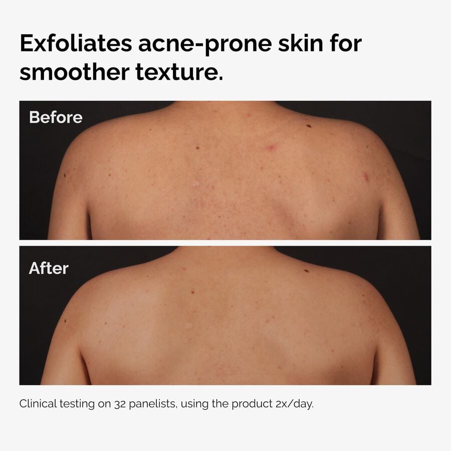 the-body-care-collection-l3 ord-salicylic-acid-body-serum-before-after-graphic-NA.jpg